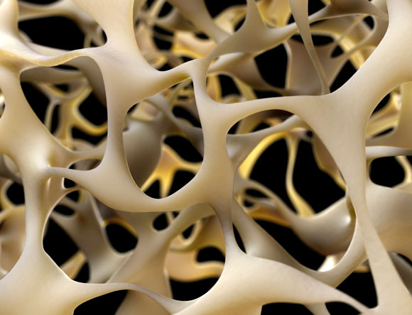 עצם של חולה אוסטאופורוזיס | איור: Science Photo Library