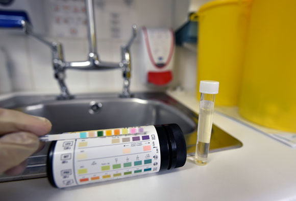 בדיקת שתן, מזהה סימנים של סוכרת, בעיות בכליות וזיהומים בדרכי השתן. צילום Science Photo Library