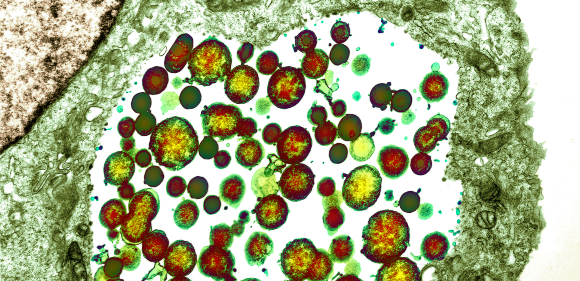 כמעט אין תסמינים, אבל בטווח הארוך עלולים להיגרם סיבוכים. חיידקי כלמידיה בתא | מקור: Science Photo Library