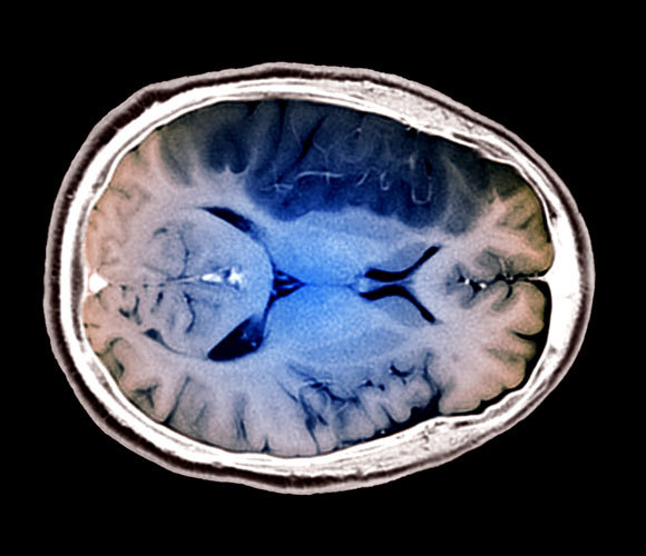 סריקת MRI של מוח לאחר שבץ. עם זאת, החוקרים מצאו רק מִתאם, לא קשר סיבתי | צילום: Science Photo Library