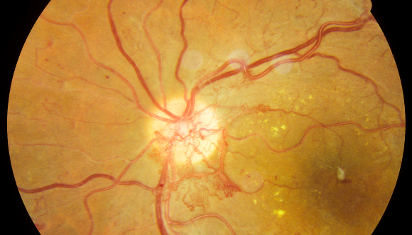 הפגיעה בכלי הדם בעין עלולה לגרום לעיוורון. צילום רשתית של חולה סוכרת | מקור: Science Photo Library