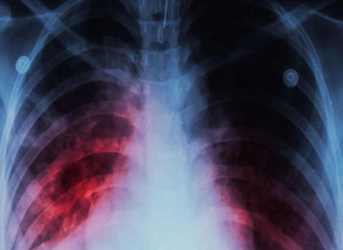 טיפול קשה וממושך, אבל בלעדיו רבים מהחולים ימותו. צילום רנטגן של חזה של חולה שחפת | צילום: Shutterstock