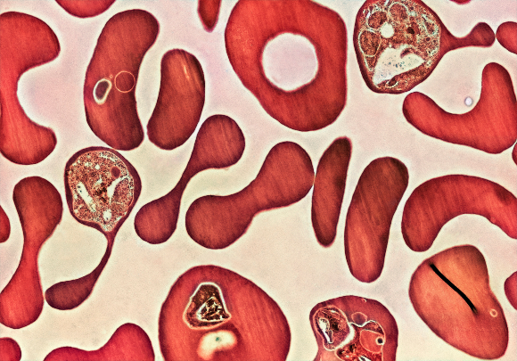 תאי דם אדומים, חלקם נגועים בטפילי מלריה. צילום צבוע במיקרוסקופ אלקטרונים | Science Photo Library