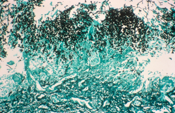 פטריות קשורות למספר מחלות והפרעות. צילום במיקרוסקופ אור של פטריות קנדידה בוושט | מקור: Science Photo Library