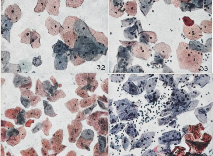 שלבים שונים בחייהם של תאי צוואר הרחם, כפי שתיעד פאפאניקולאו עצמו (צילום מיקרוסקופי צבוע) | מקור: Wellcome Collection