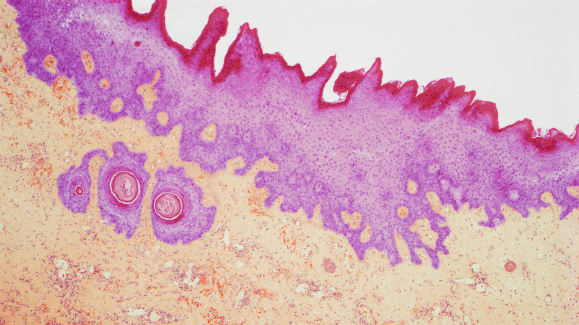 הגוף נכנס להלם מהרעלנים שהחיידק מפריש. צילום במיקרוסקופ אור של רקמה בתהליך נמק | Science Photo Library