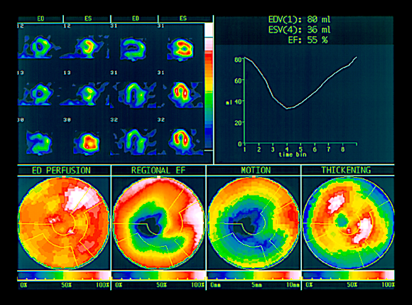 בדיקות שמבוצעות לאחר התקף לב | Science Photo Library