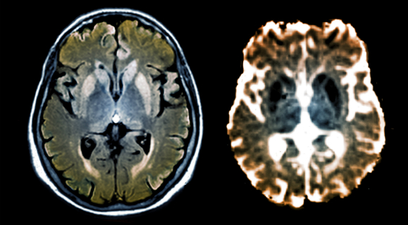 מחלות מורכבות יותר ממה שחשבנו. סקירות מוח של חולה במחלת הפריונים קרויצפלד-יעקב | מקור: Science Photo Library