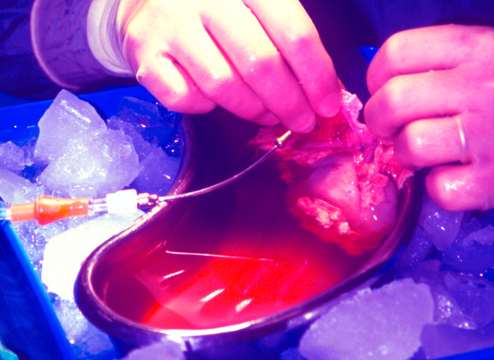 פתרון אפשרי לרבים הממתינים לאיברים. הכנה של כליה להשתלה בניתוח | צילום: Science Photo Library