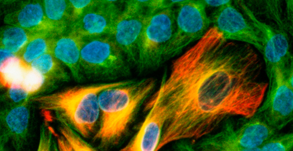 הפעלת מערכת החיסון למלחמה משופרת בגידולים. תאים סרטניים צבועים | צילום: Science photo Library