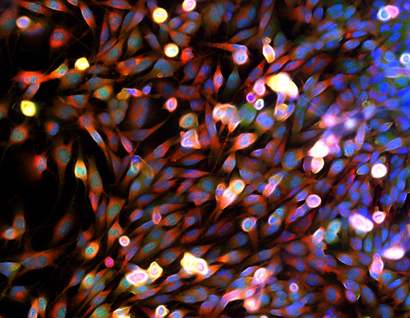 תאי סרטן shutterstock