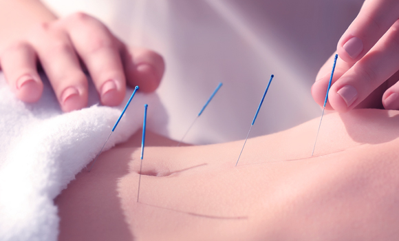 דיקור סיני sutterstock