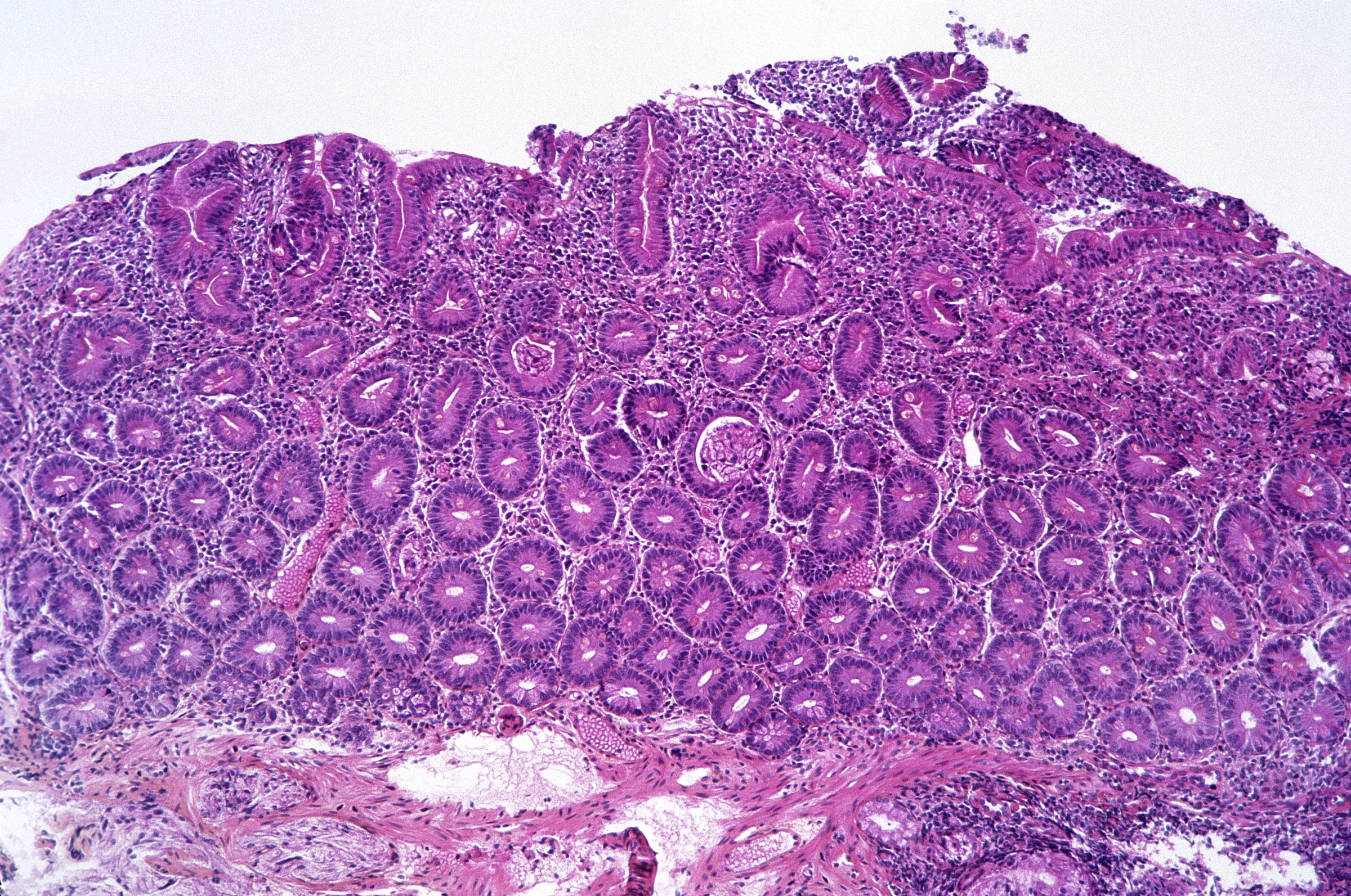 התגובה החיסוניות גורמת לדלקת כרונית. דופן המעי הדק של חולה צליאק (צילום במיקרוסקופ) | מקור: Science Photo Library