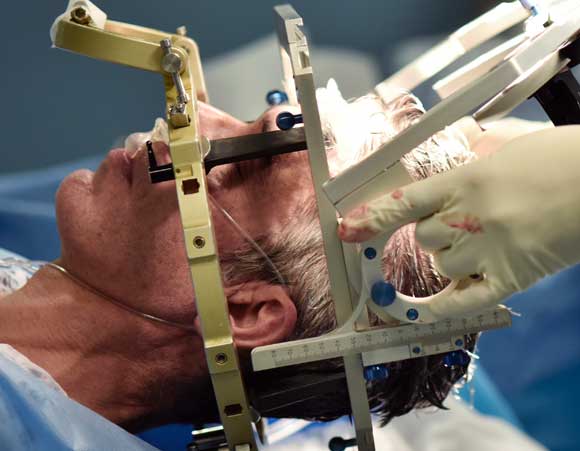 גירוי מקומי באמצעות השתלת אלקטרודות במוח. טיפול להקלת התסמינים אצל חולה פרקינסון | צילום: Science Photo Library