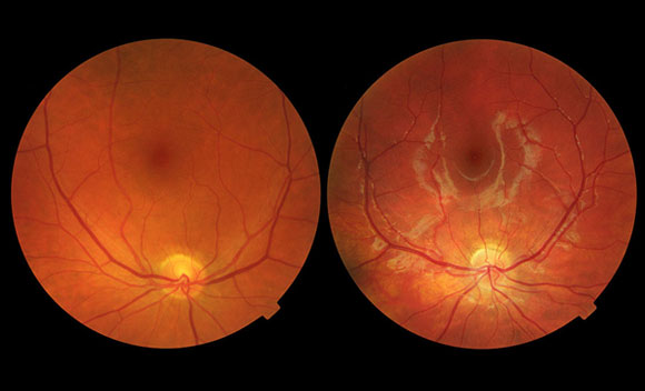 כלי דם מרובים ומשקעים ברשתית. עין של חולה בניוון מקולרי (מימין) ורשתית של עין בריאה | מקור: ויקיפדיה