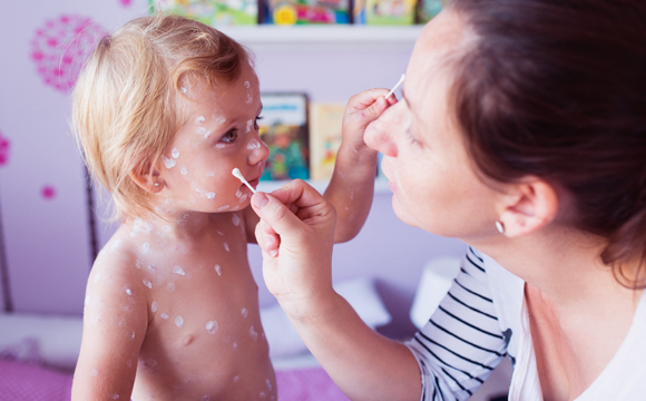 סיבוכים מסוכנים. מריחת משחה להרגעת הגירוד. למעלה: ילדה "פורחת" | צילומים: Shutterstock, Science Photo Library