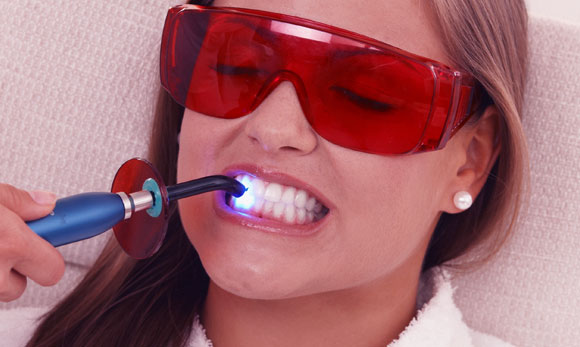 התאורה מזרזת את תהליך החימצון ומאיצה את הלבנת השיניים | צילום: Shutterstock