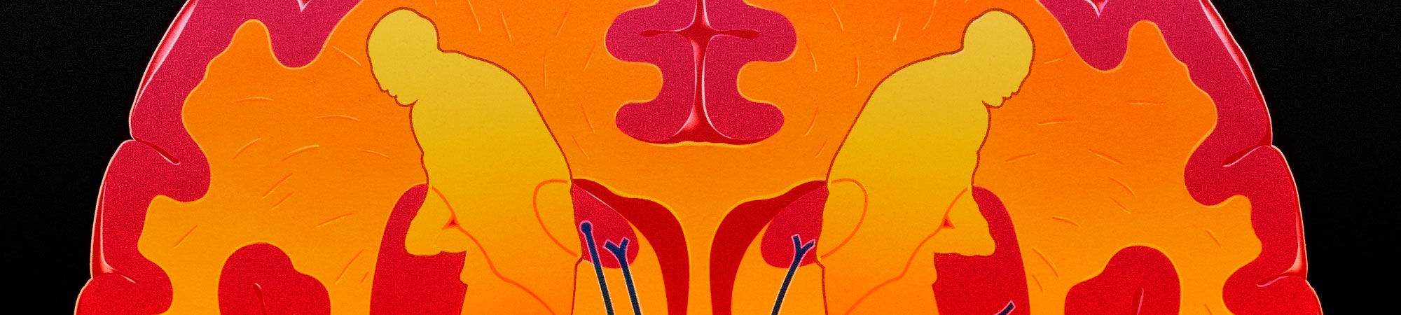 Parkinson’s Disease: Catching the Early—and small—Signs